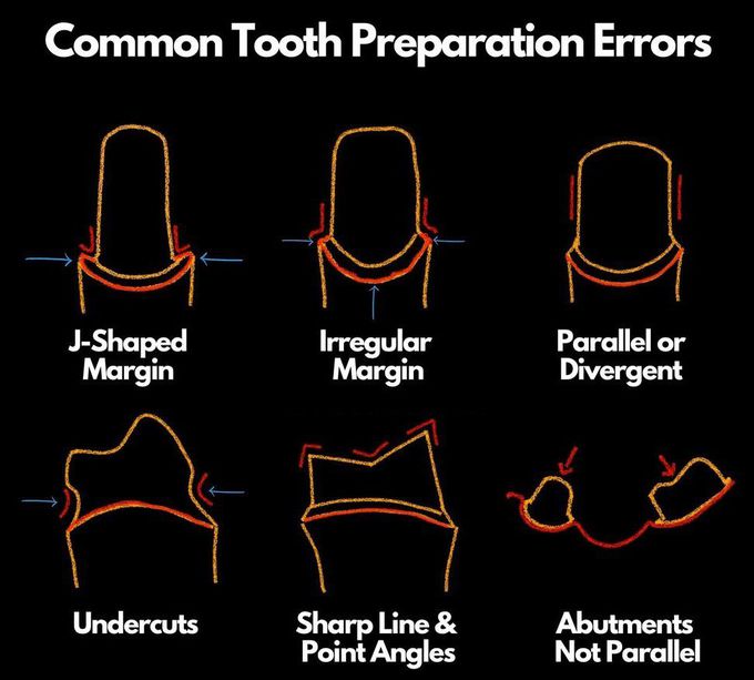 Common Tooth Preparation Errors