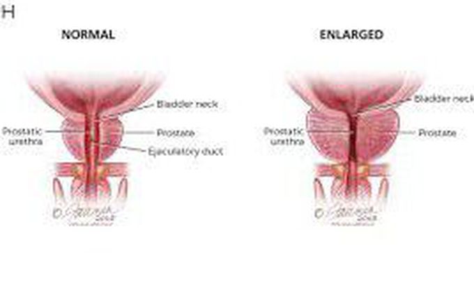 Symptoms of benign prostatic hyperplasia