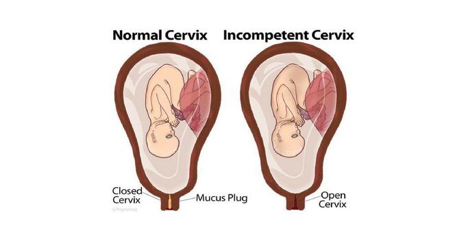 What causes incompetent cervix?
