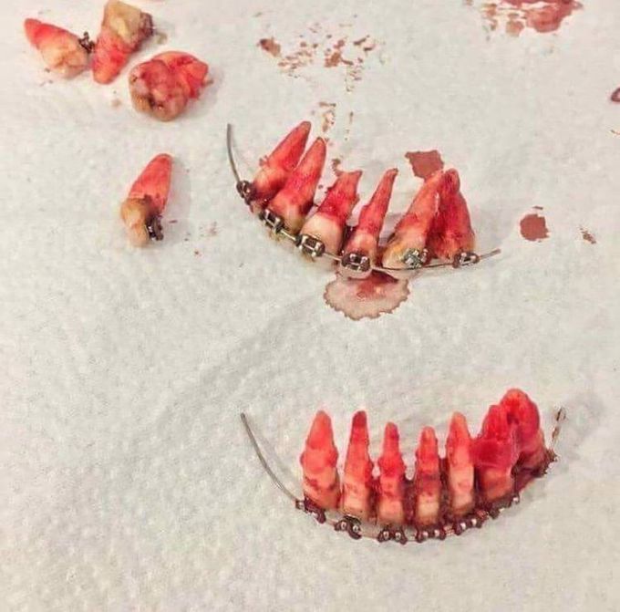 A severe trauma of a 25 years old male after a motorcycle accident🙄🏍 , do you think that his braces protected his teeth or  damaged him ??