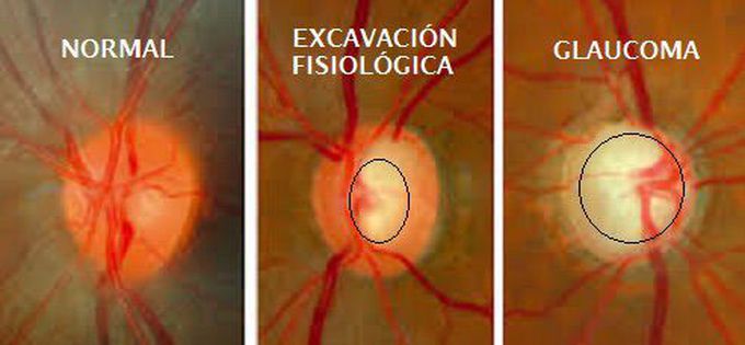 Excavació fisiológica / glaucoma