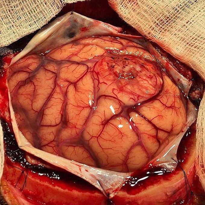 Brain metastasis