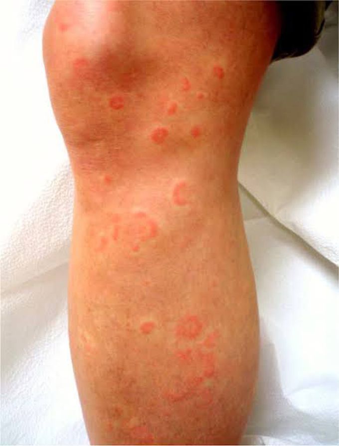 Erythema Multiforme Causes