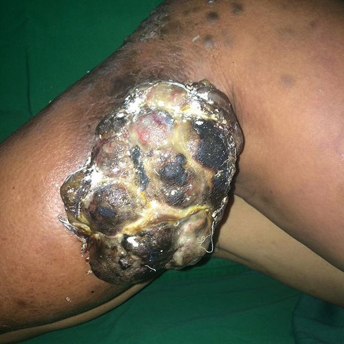 Advanced case of malignant melanoma
