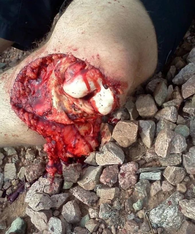 Bike riding goes terribly wrong! 