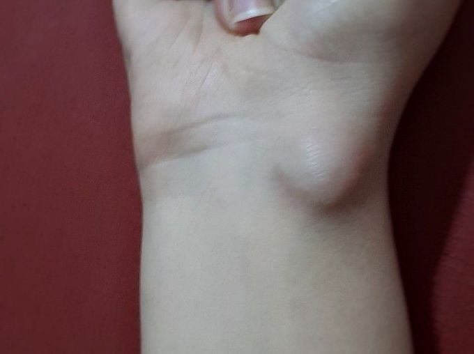 i have tendonitis in my wrist😶😍
