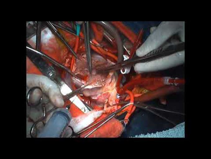 Left Ventricular Fibroma Excision
