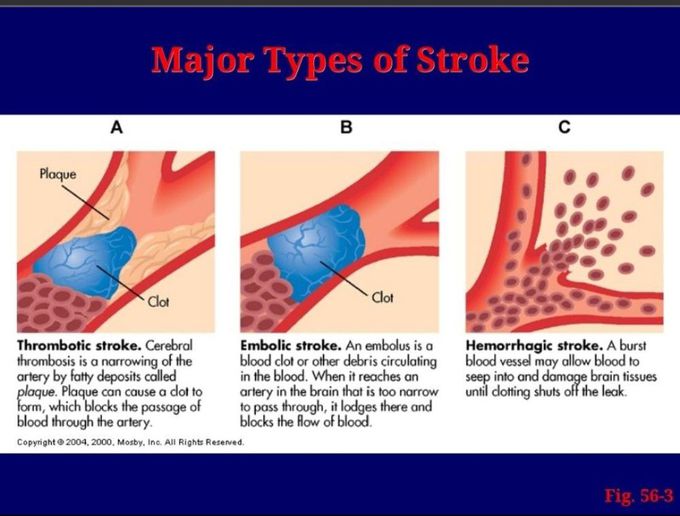 Stroke