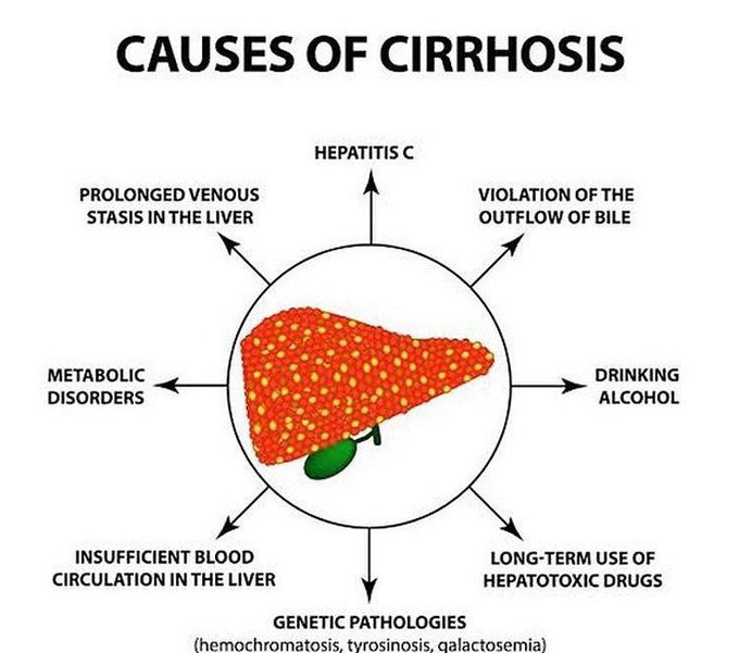 Causes of cirrhosis