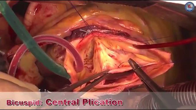 Video-atlas of aortic valve repair: bicuspid