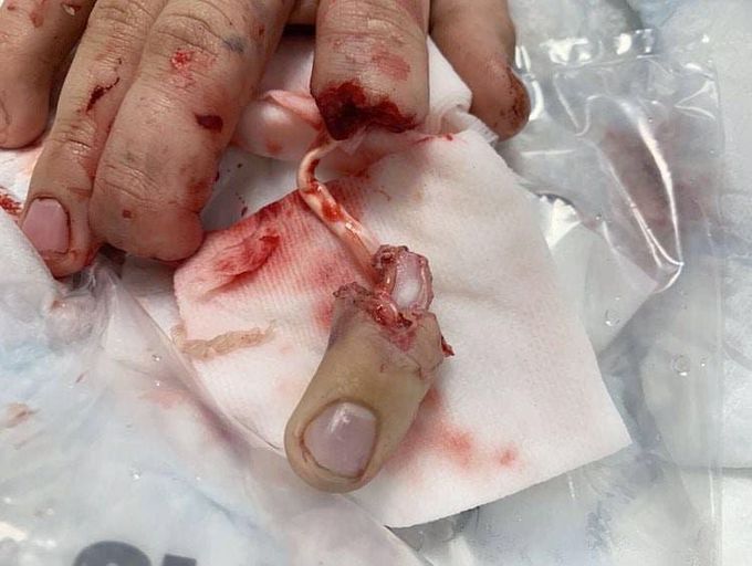 Motorcycle accident causing index finger amputation with tendon avulsion! 
