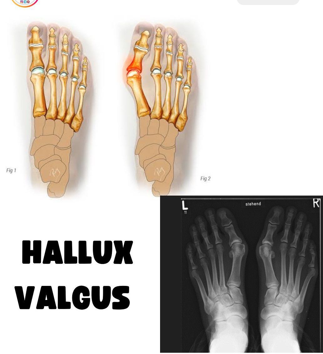 Hallux Valgus - MEDizzy