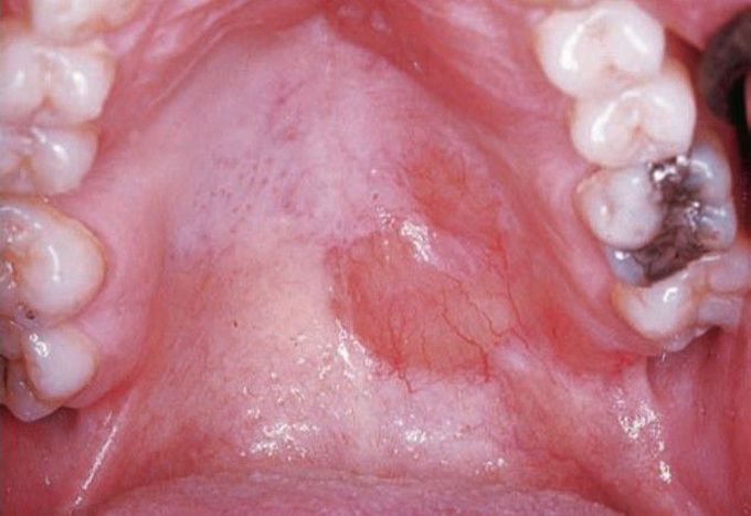 Hodgkin Vs Non-Hodgkin Lymphoma - MEDizzy