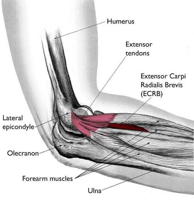 Lateral Epicondylitis