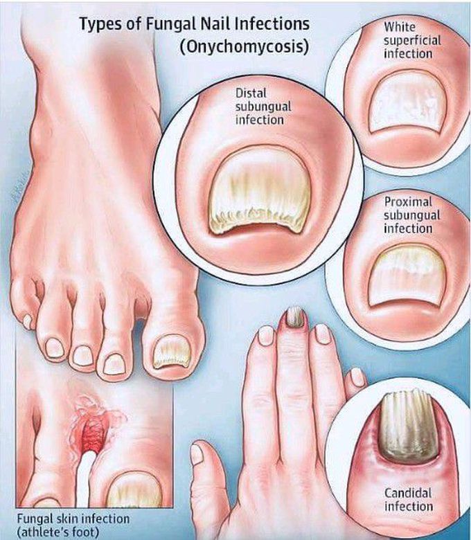 Nail infection