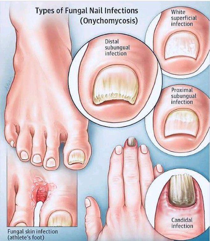 Nail infection - MEDizzy