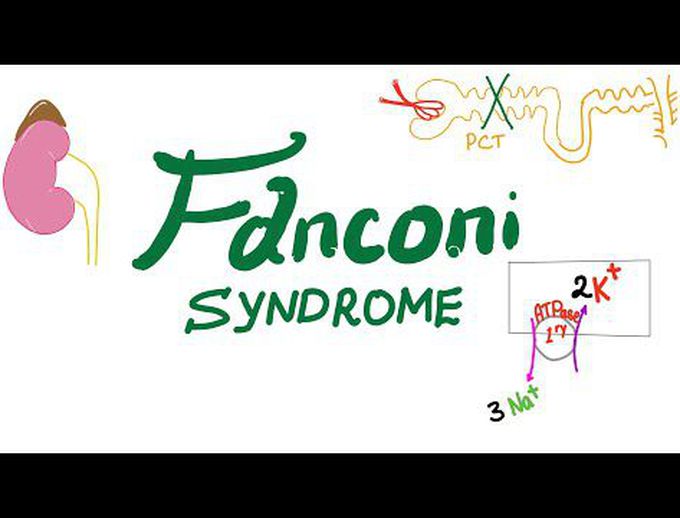Fanconi Syndrome (Proximal convoluted tubule defect)