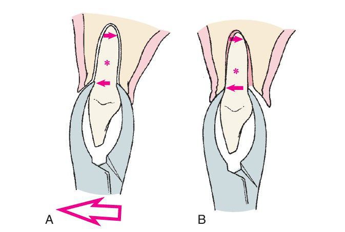 Extraction forceps placement - MEDizzy