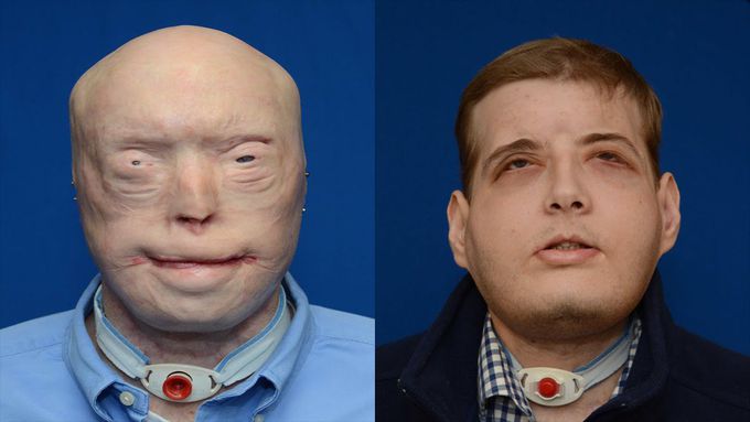 Face transplant