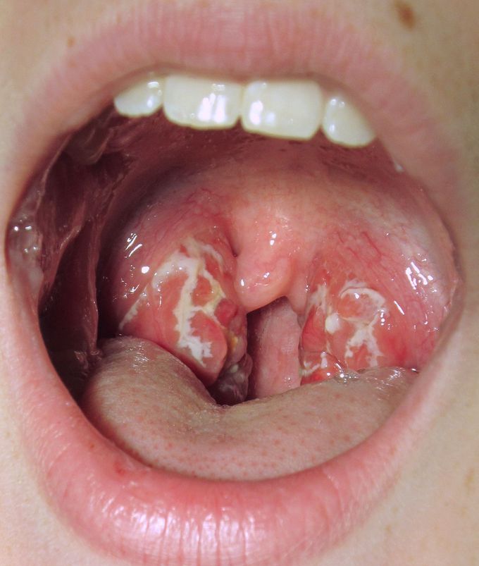 Pharyngitis