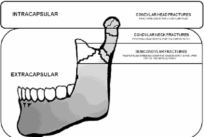 Condylar fracture