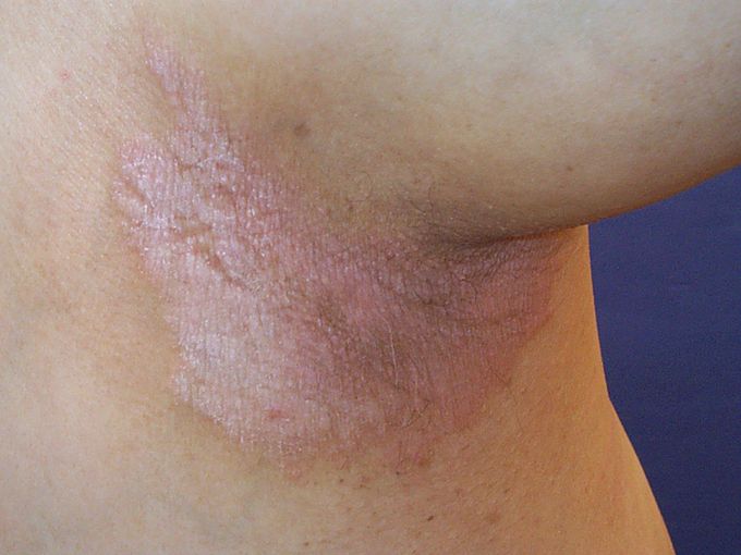 Inverse psoriasis