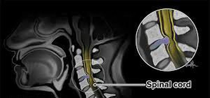 Cervical spondylosis