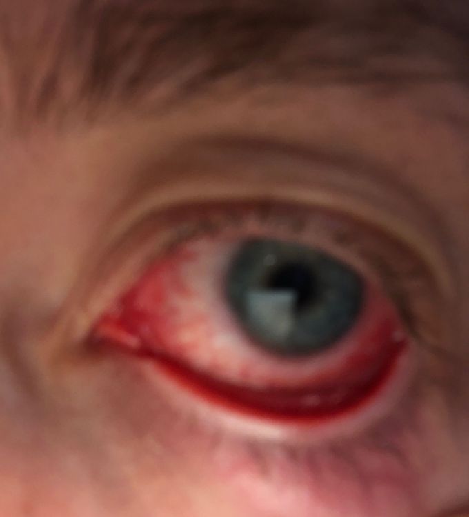 Conjuntivitis Every 2 weeks…