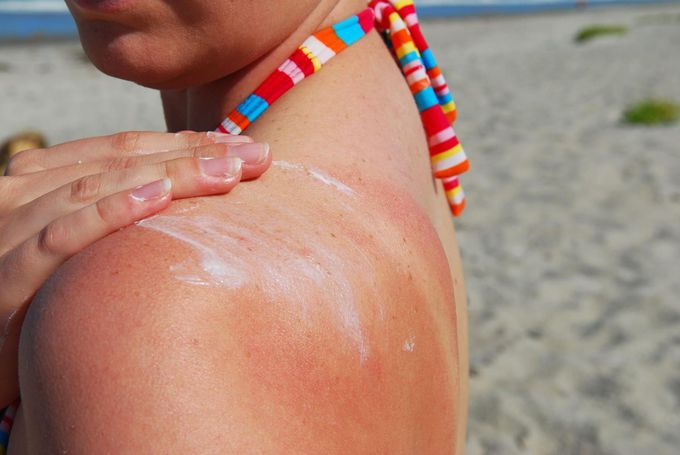 Symptoms of Sunburn