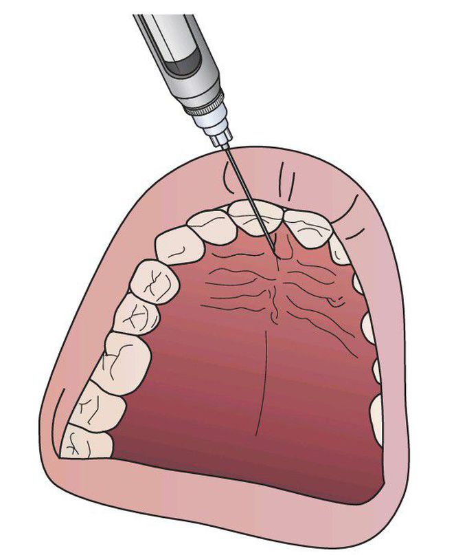 Incisive nerve infiltration