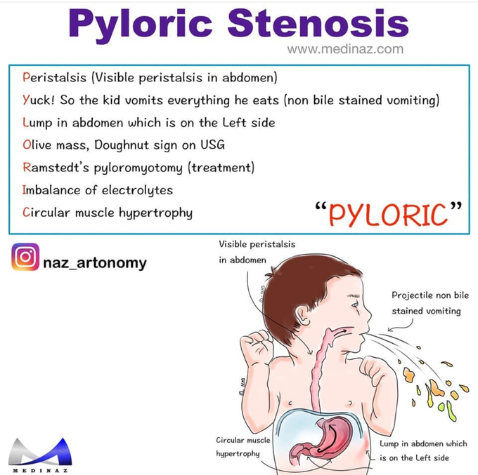 Pyloric stenosis