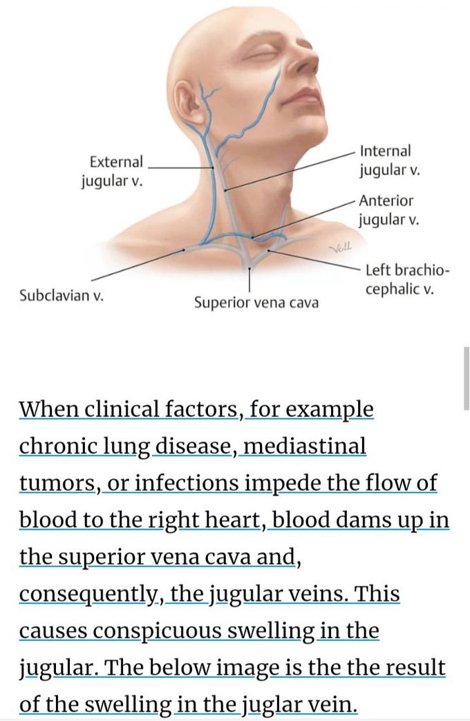 carotid Arteries