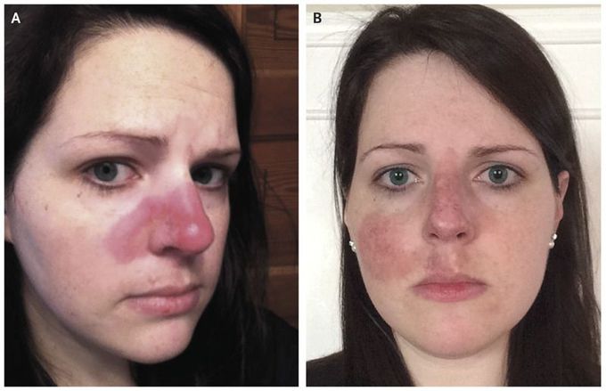 Cutaneous Lupus — “The Pimple That Never Went Away”