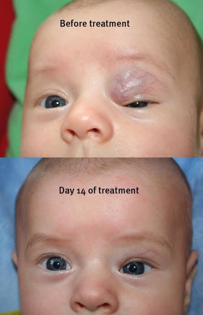 Treatment of hemangioma