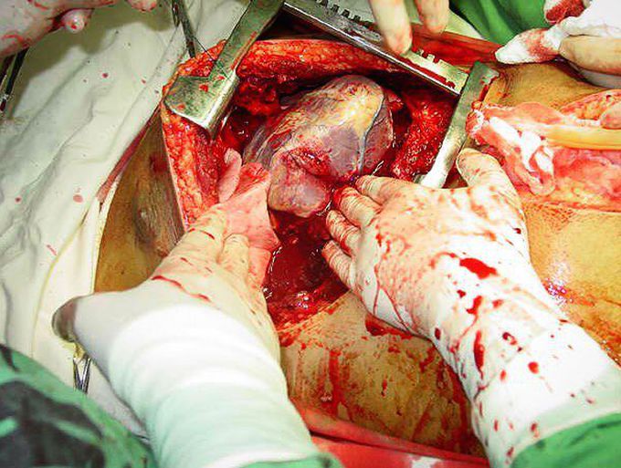 Emergency exploratory thoracotomy done after a traumatic chest injury! 