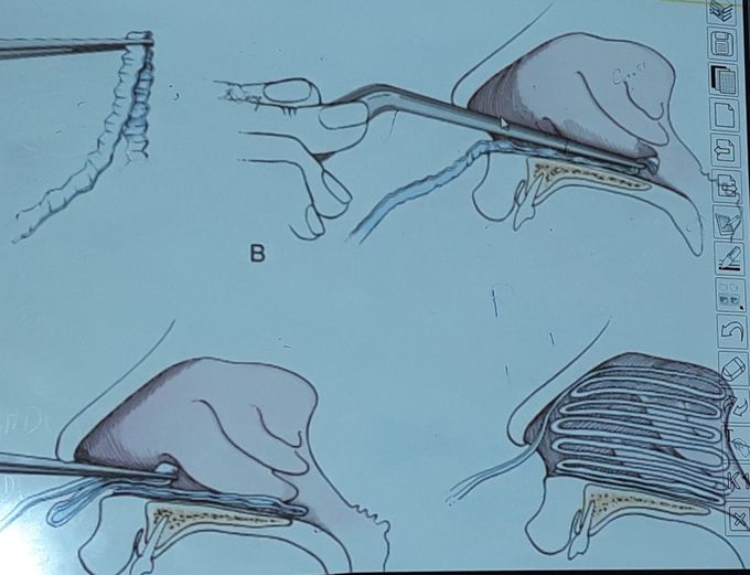 Anterior packing