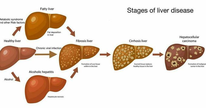 Stages of liver disease