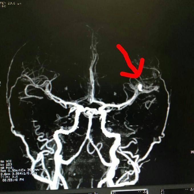 Middle Cerebral Artery Aneurysm - MCA