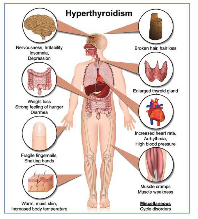 How is hyperthyroidism treated?