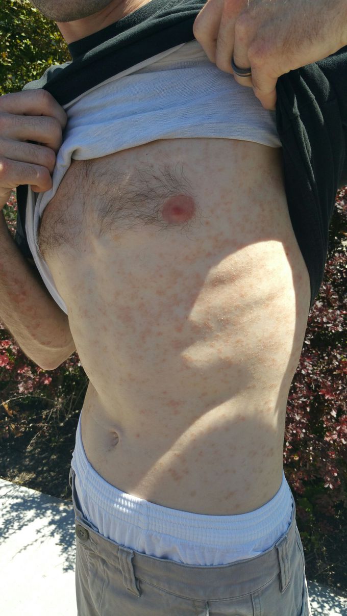 pityriasis rosea