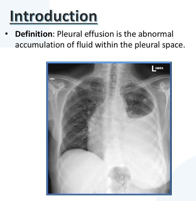 Pleural Effusion I