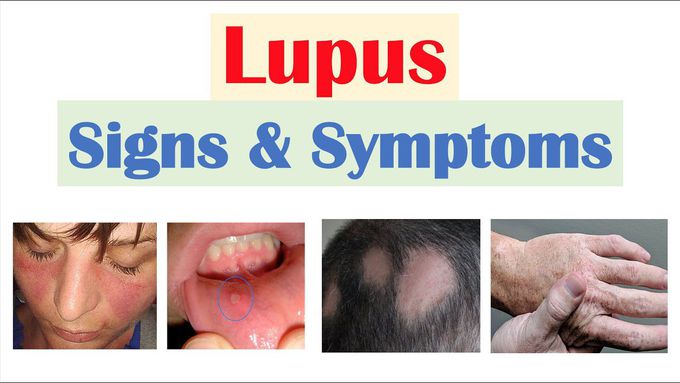 Lupus Signs & Symptoms