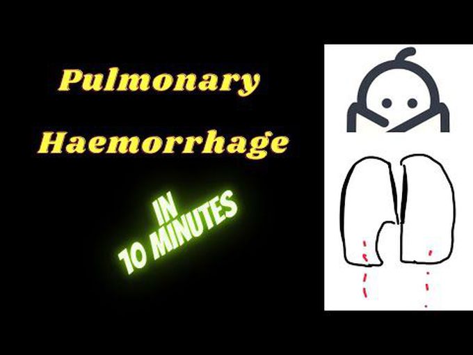 What is Pulmonary Haemorrhage?