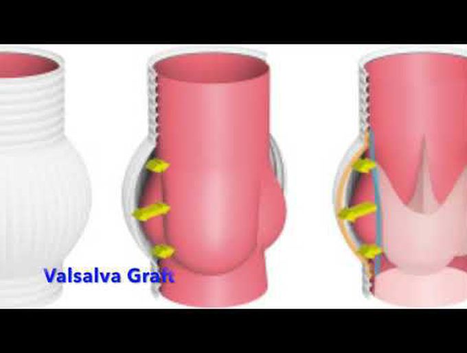 Modified David With a Valsalva Graft