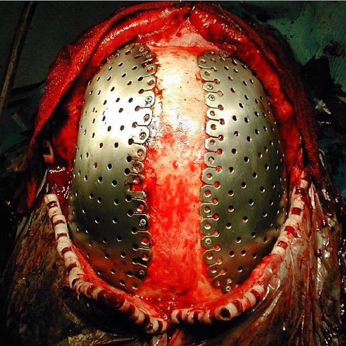 Cranioplasty