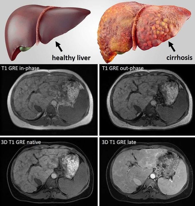 High resolution MR Imaging of the cirrhotic liver at 1.5 Tesla
