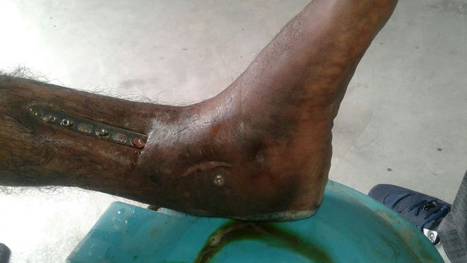 Bone fracture