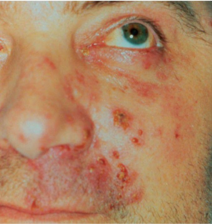 Herpes zoster infection