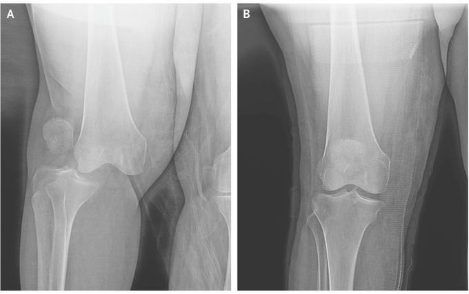 Lateral Knee Dislocation
