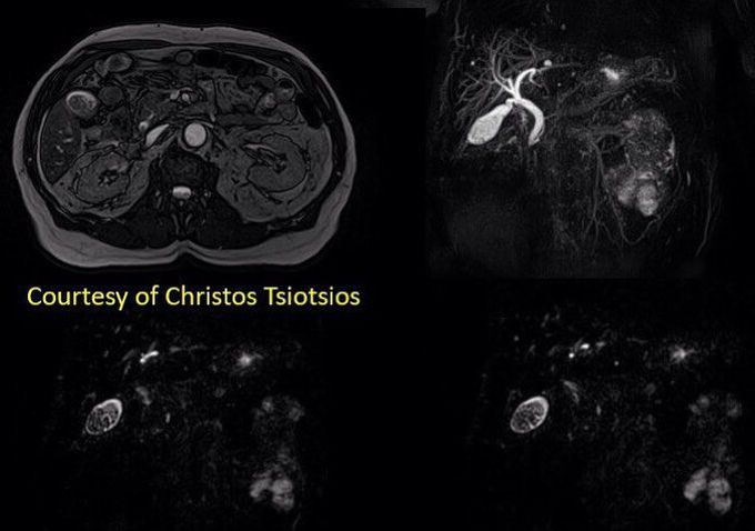 Magnetic resonance cholangiopancreatography (MRCP)